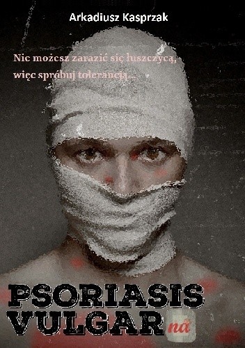 Psoriasis Vulgarna
